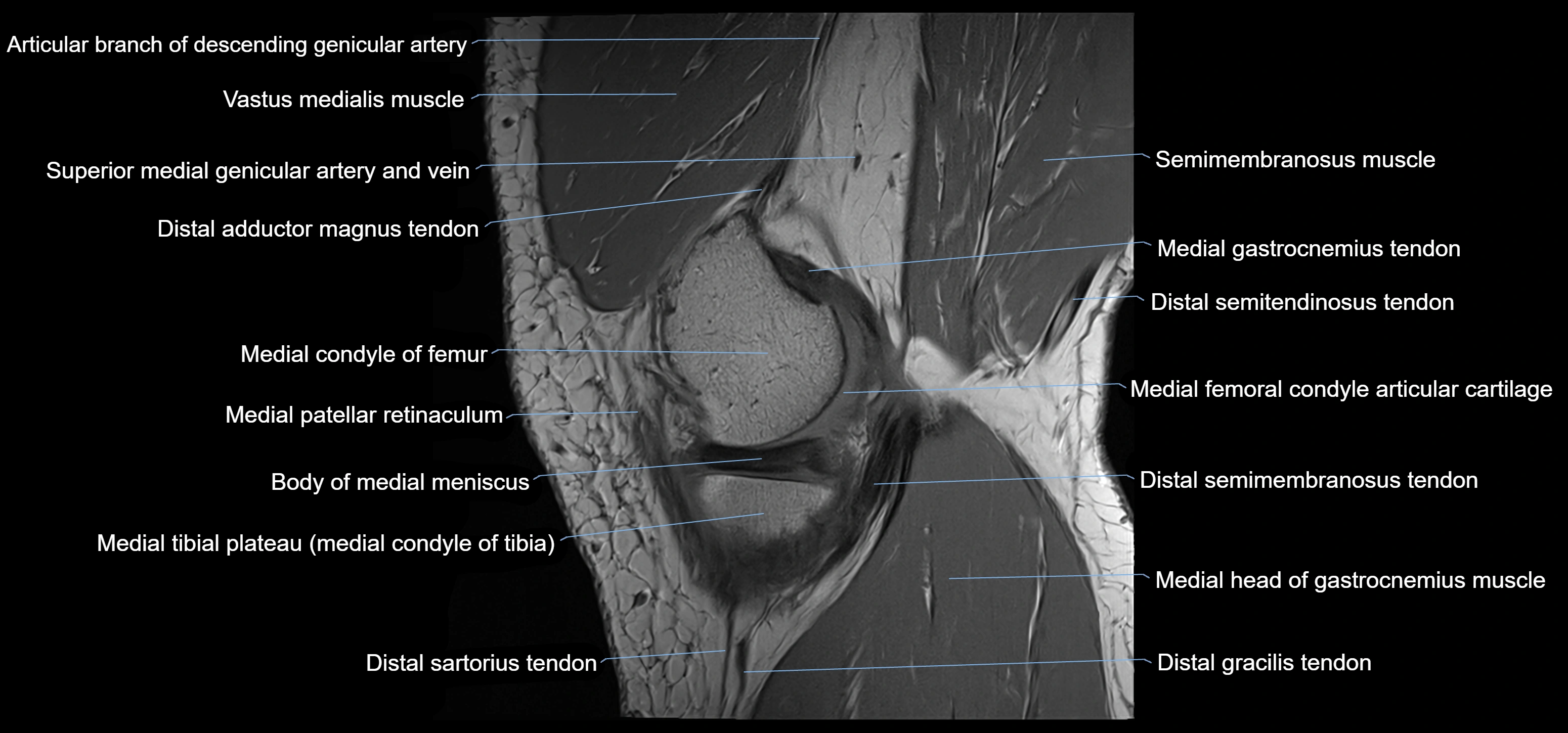 MRI knee sagittal cross sectional anatomy labelled 3T radiology image-00011.webp